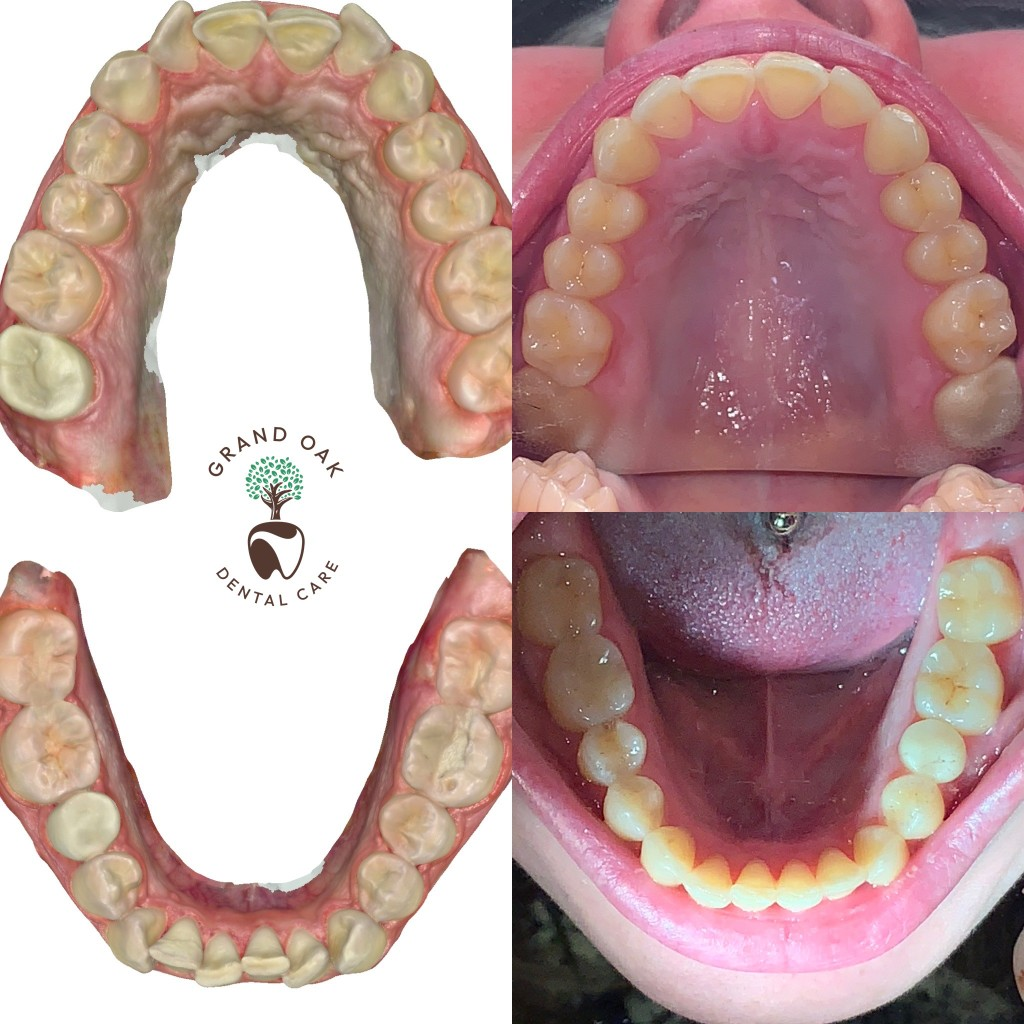 Comprehensive Dual Arch Alignment